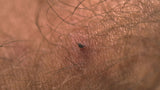 Lifesystems Tick Remover Tool (Compact Card)